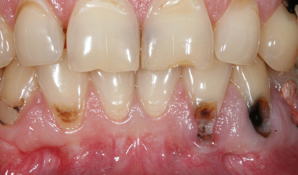 Причины оголения зубов и методы его предотвращения