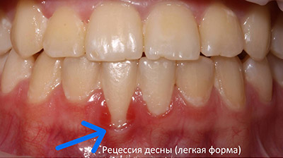 Как справиться с воспалением на корне зуба?