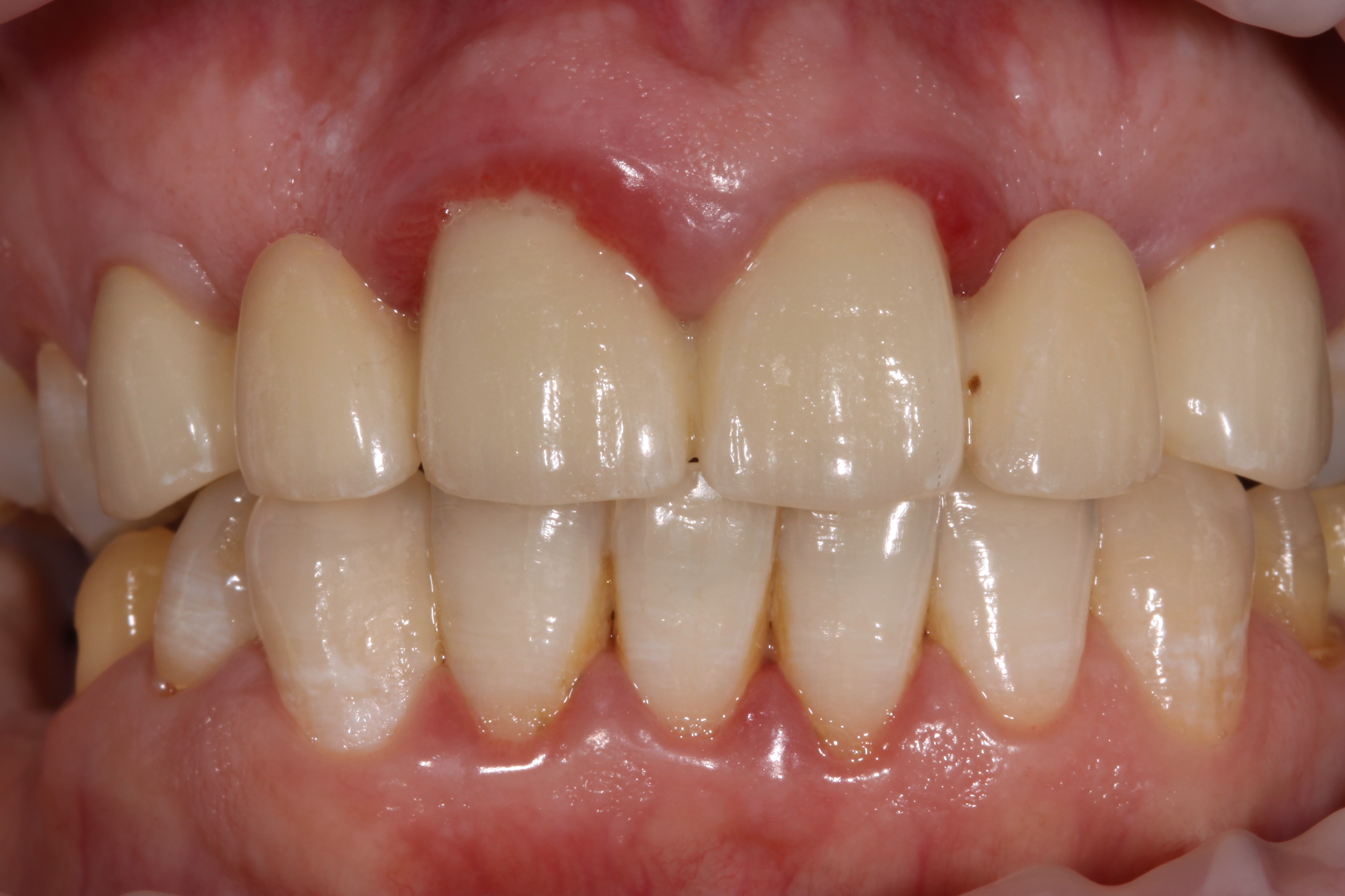 Коронки на передние зубы – ставить или нет?