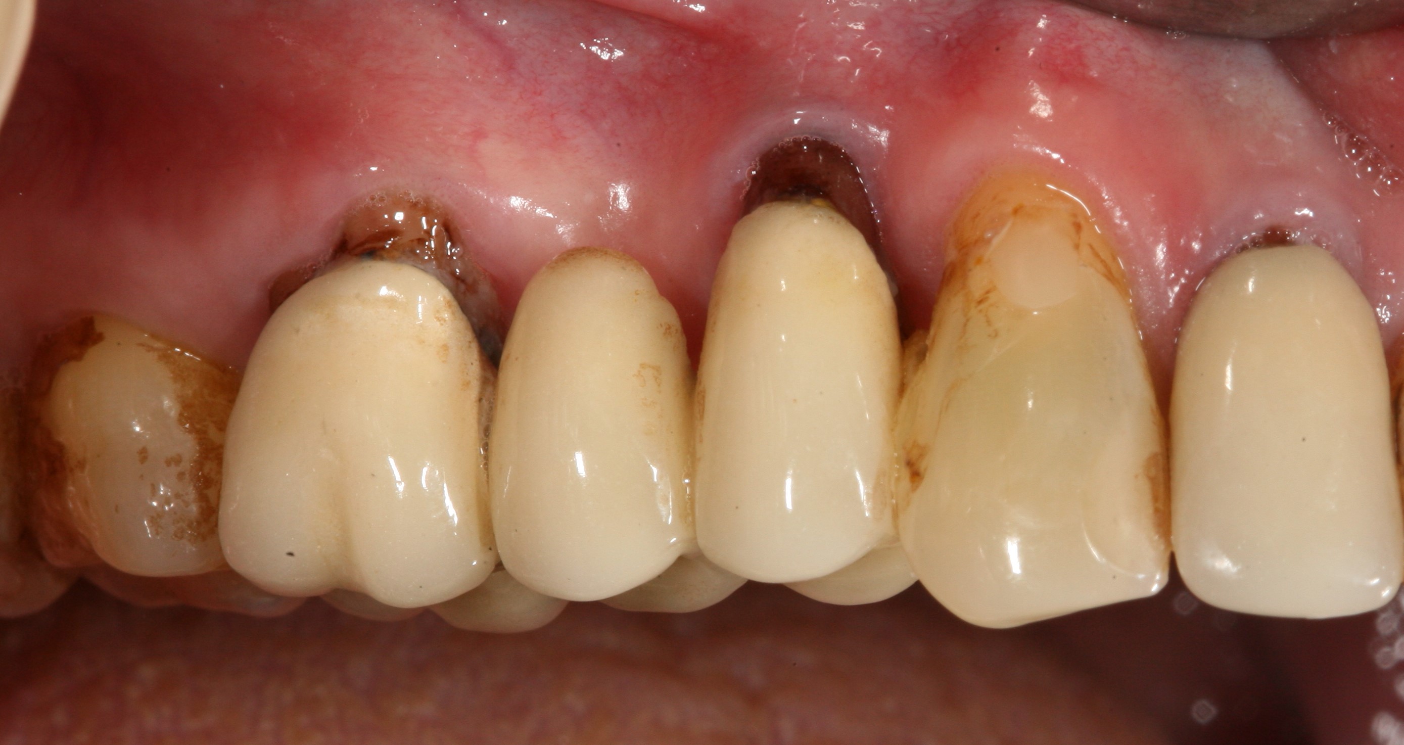 Лечение зуба под коронкой без снятия коронки
