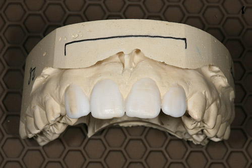 В каких случаях необходима реставрация передних зубов?