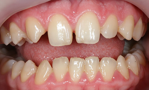 Пациентка обратилась с жалобами на эстетически неудовлетворительный вид зубов