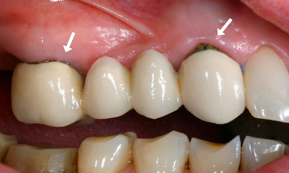 Десна не прилегает к зубу стоматология улыбка лазо томск