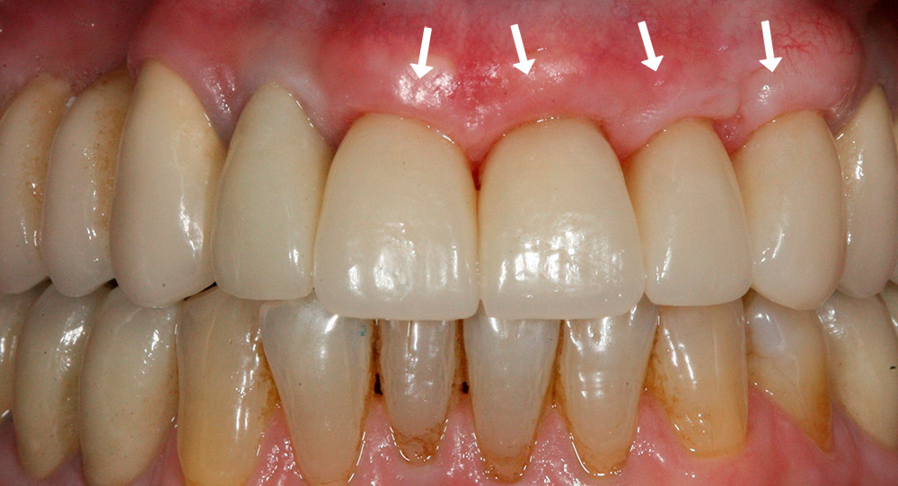Щели между зубом и коронкой, трещины керамического слоя. Как избежать?