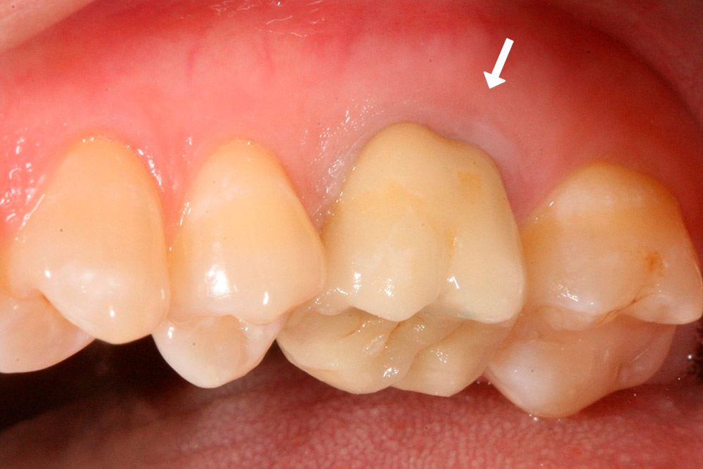 Как отбелить зубы в домашних условиях: что лучше всего?
