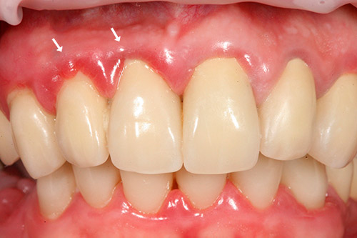 Кровоточивость дёсен, особенно при чистке зубов