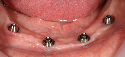 4 имплантата на нижней для фиксации Несъёмного протеза