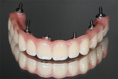 Зубные протезы Акри Фри (Acry-Free)