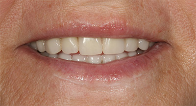 Если съемный зубной протез спадает, его можно починить?