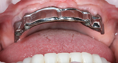 Нет жевательных зубов — что делать, какой протез поставить