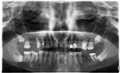 Киста по причине неправильно расположенного нижнего зуба мудрости