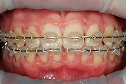 Зубы очищены и повторно окрашены — зубного налета не выявляется