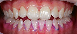 Пример использования красителей для выявления зубного налета — после