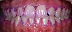 Пример использования красителей для выявления зубного налета — до