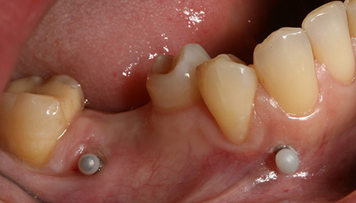 Ортодонтические имплантаты, установленные временно для перемещения неправильно расположенного зуба