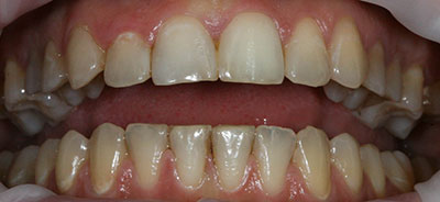 Применен метод внутреннего отбеливания зуба
