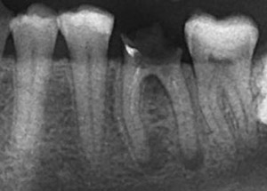 Периодонтит нижнего коренного зуба