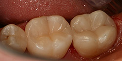 поверхность зубов восстановлена пломбировочным материалом