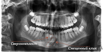 сверхкомплектный зуб неправильной формы в переднем отделе нижней челюсти