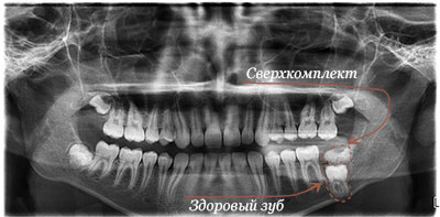 сверхкомплектный зуб неправильной формы над нижним боковым зубом
