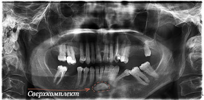 сверхкомплектный зуб в переднем отделе нижней челюсти