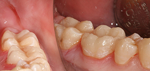 керамическая реставрация зафиксирована на поврежденный зуб
