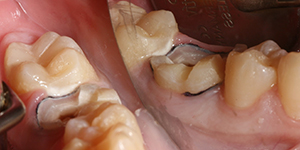 значительное разрушение поверхности зуба