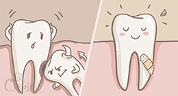 Удаление зубов - Непрорезанные зубы