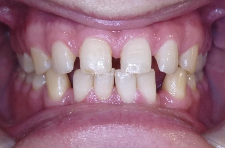 Промежутки между зубами и правильное дыхание