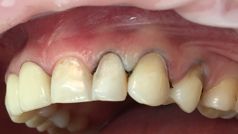 Кариозные полости на зубах в переднем отделе