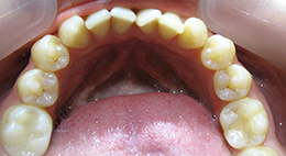 Выраженная скученность зубных рядов