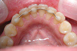 Было создано место для всех зубов в зубной дуге без удаления