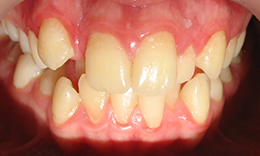 В зубном ряду полностью отсутствует место для бокового резца верхней челюсти справа