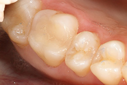 Восстановление разрушенных тканей зуба