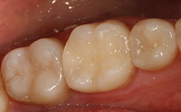 Восстановление утраченных тканей зуба