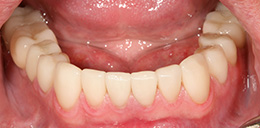 Полное восстановление зубных рядов