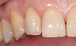 Зуб восстановлен керамической коронкой