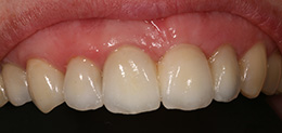 Восстановление зубов при помощи мостовидного протеза