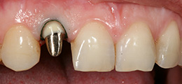 Зуб разрушен до уровня десны