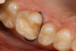 Разрушение поверхности зуба