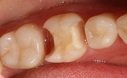 Значительное разрушение поверхности зуба
