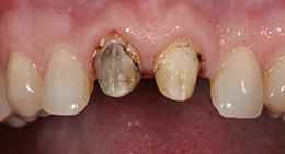 Разрушение твердых тканей зуба