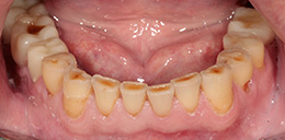 Выраженная стираемость зубов нижней челюсти