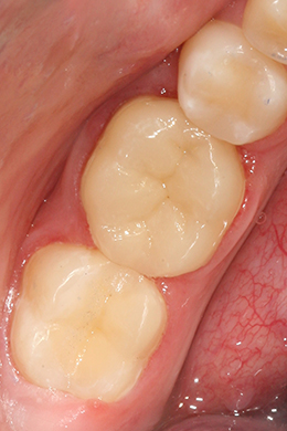 Анатомическая форма зуба 7 восстановлена