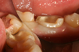 Значительное разрушение твердых тканей зуба