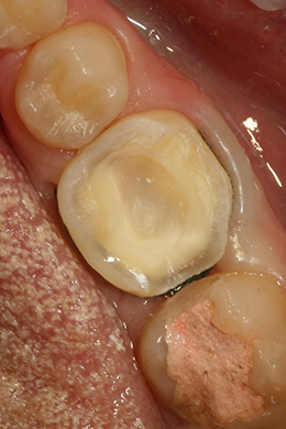Зуб 6 — значительное разрушение твердых тканей