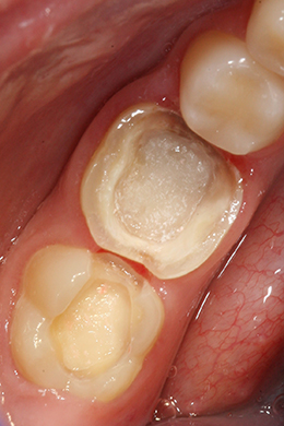 Значительное разрушение твердых тканей зуба